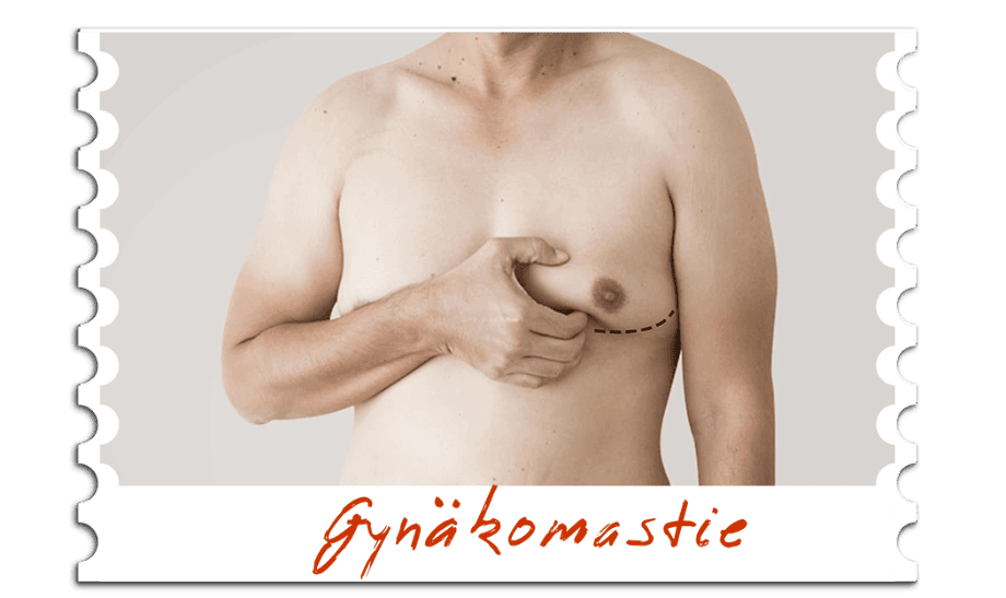 Gynäkomastie