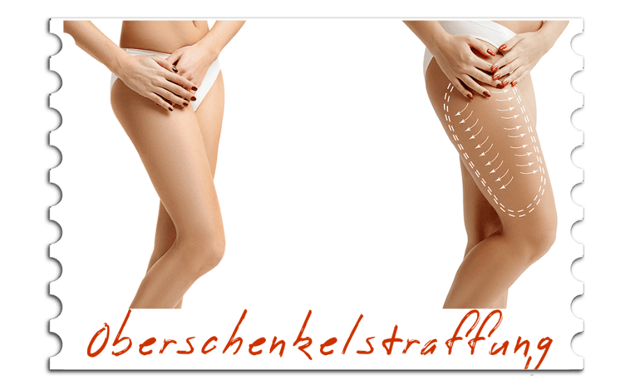Oberschenkelstraffung