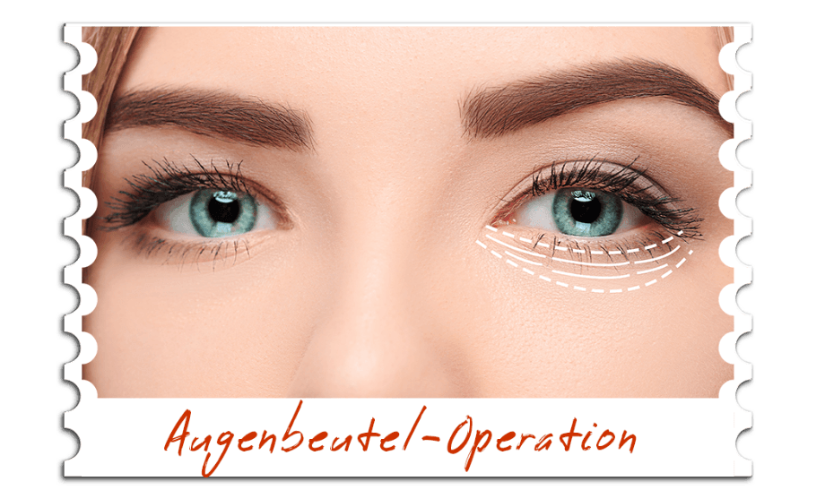 Augenbeutel-Operation