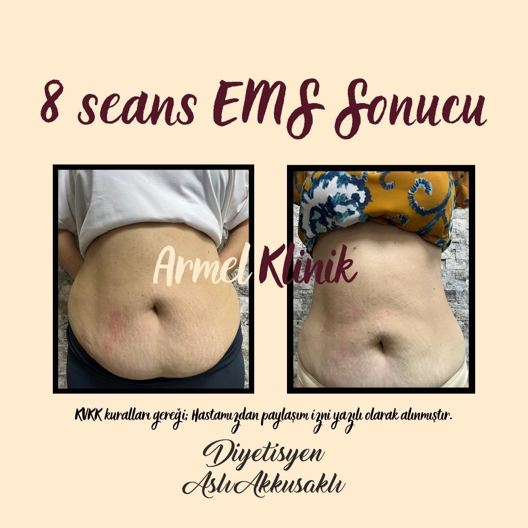 8 SEANS KARIN BÖLGESİ SIKILAŞTIRMA- YAĞ YAKIMI