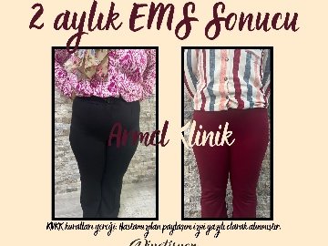 2 AYLIK EMS SONUCU -23 KG