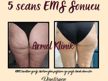 KALÇA KALDIRMA VE SIKILAŞTIRMA + SELÜLİT AZALTMA