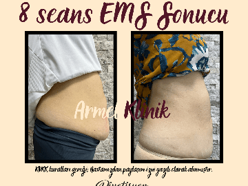 KARIN SARKMASI DÜZELTME VE YAĞ YAKIMI