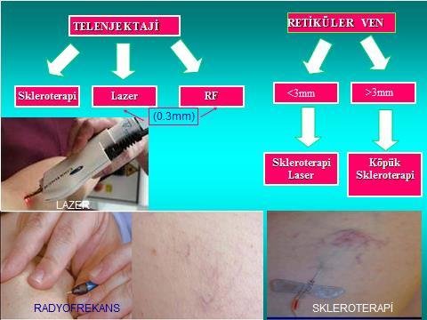 kılcal varis tedavisi