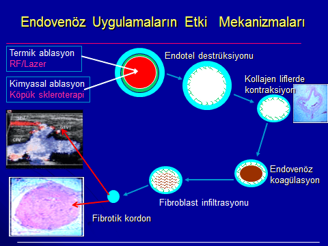 varis tedavisinde lazer'in etki mekanizması