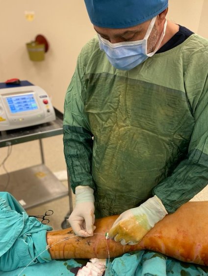 VARİS TEDAVİSİNDE DAMAR İÇİ LAZER KULLANIMI