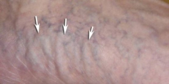 KORONA FLEBEKTATİKA