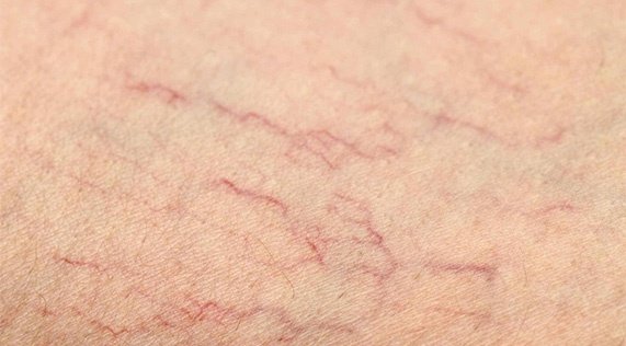 Kılcal Varis Nasıl Görünür