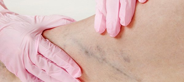 Varisler-kaç-çeşittir