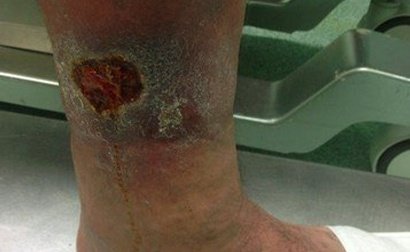 Venöz-Bacak-Ülseri