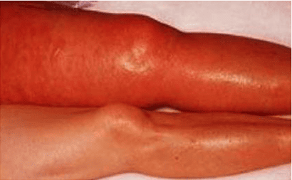 toplar-damar-tıkanıklığı