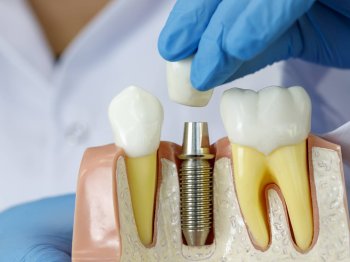 İmplant Tedavisi Nedir?