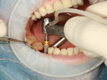 implant tedavisi sonrası neler yapılmalıdır?