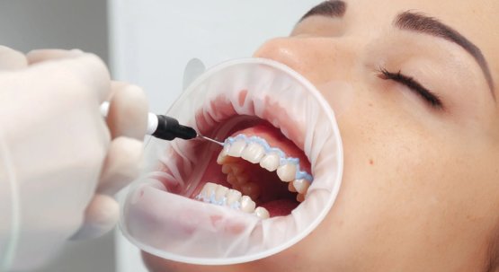 Diş Beyazlatma Hakkında Doğru Bilinen Yanlışlar: Beyaz Bir Gülüş Hayal mi?