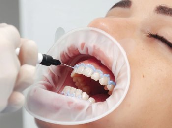 Diş Beyazlatma Hakkında Doğru Bilinen Yanlışlar: Beyaz Bir Gülüş Hayal mi?