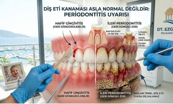 Diş Eti Kanaması Neden Olur? Gizli Tehlike: Periodontitis