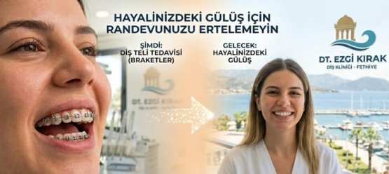 Diş Teli (Braket) Tedavisi: Hayalinizdeki Gülüş İçin Randevunuzu Ertelemeyin.