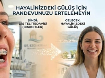 Diş Teli (Braket) Tedavisi: Hayalinizdeki Gülüş İçin Randevunuzu Ertelemeyin.