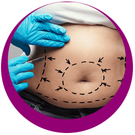 BAUCHDECKENSTRAFFUNG