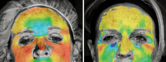 3 Boyutlu Resimleme ve Botoks Sonuçları | DK Klinik