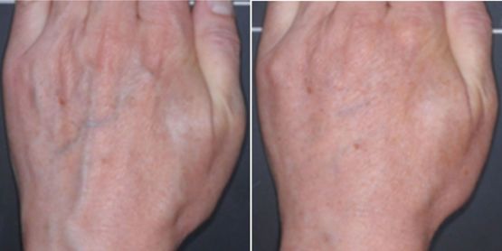 El Kırışıklıklarına Veda Edebilirsiniz | DK Klinik