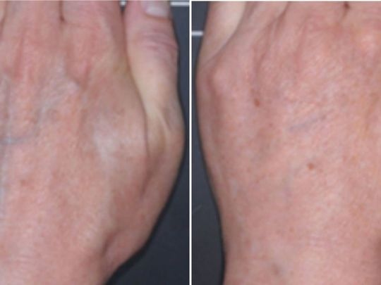 Artık El Kırışıklıklarınıza Veda Edebilirsiniz...