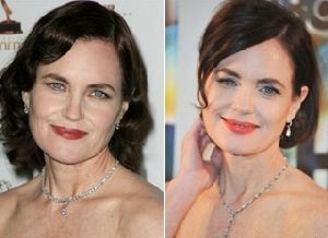 Volüm Dolguları | DK Klinik