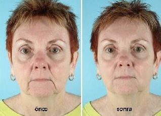 Marionette Çizgileri