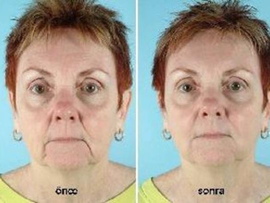 Marionette Çizgileri