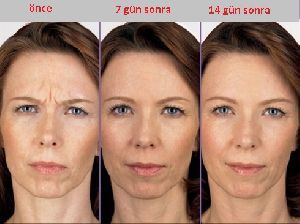 Botoks Uygulaması Size uygun mu?