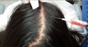 Saç dökülmesi ve PRP tedavisi