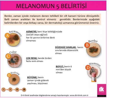 Bir Cilt Kanseri Türü Olan Melanomun 5 Belirtisi