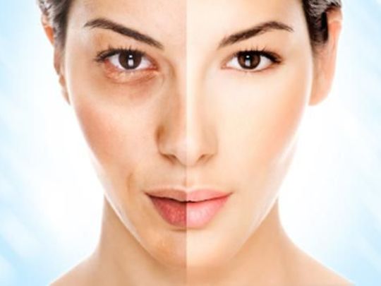 Cilt Lekeleri Tedavisi