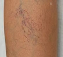 kılcal damartedavisi 3