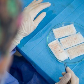 Im Jahre 2015 haben wir unsere erste Haartransplantation durchgeführt