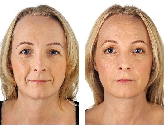 Cilt Dolguları ve Kırışıklık Tedavisi | DK Klinik