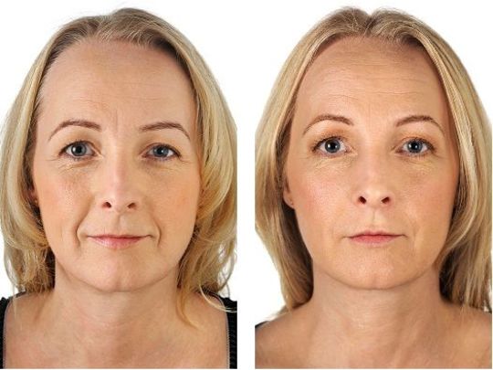 Cilt Dolguları ve Kırışıklık Tedavisi