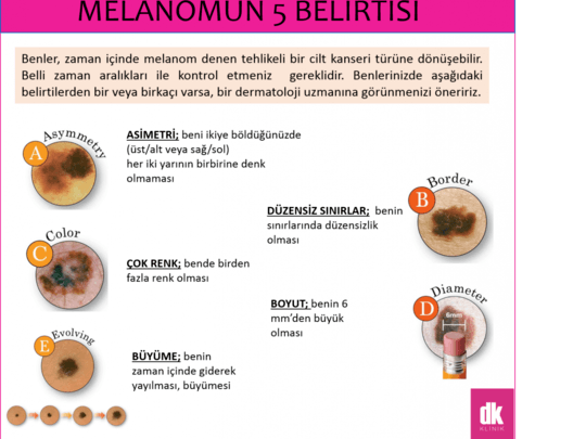 Bir Cilt Kanseri Türü Olan Melanomun 5 Belirtisi