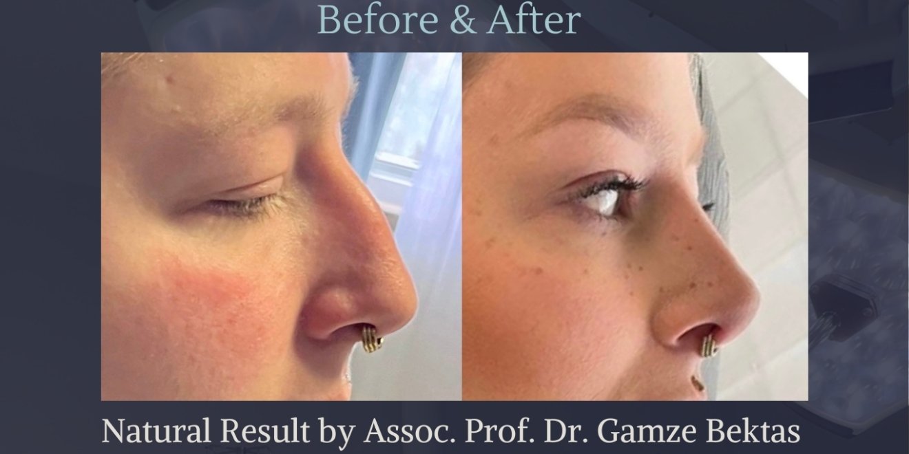 Rhinoplasty Istanbul | Assoc. Prof. Dr. Gamze Bektas | Piezzo Surgery