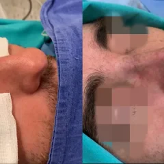 Dorsal hump removal and nasal tip refinement, successful rhinoplasty outcome. (7)