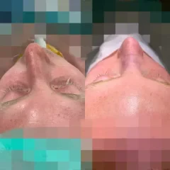 Rhinoplasty before and after results by Assoc. Prof. Dr. Gamze Bektas in Istanbul. (6)