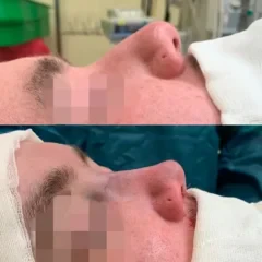 rhinoplasty-before-after-gamze-bektas.webP veya nisantasi-nose-job-istanbul webP