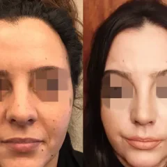 Natural nose job result for a female patient, Nisantasi clinic (3)