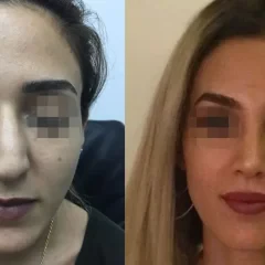 Natural nose job result for a female patient, Nisantasi clinic. (4)