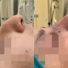 Dorsal hump removal and nasal tip refinement, successful rhinoplasty outcome.