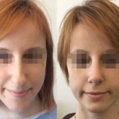Rhinoplasty before and after results by Assoc. Prof. Dr. Gamze Bektas in Istanbul. (3)