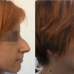 Rhinoplasty before and after results by Assoc. Prof. Dr. Gamze Bektas in Istanbul. (2)