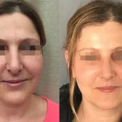 Rhinoplasty before and after results by Assoc. Prof. Dr. Gamze Bektas in Istanbul.