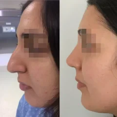 Dorsal hump removal and nasal tip refinement, successful rhinoplasty outcome. (6)