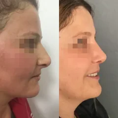 Rhinoplasty before and after results by Assoc. Prof. Dr. Gamze Bektas in Istanbul. (5)